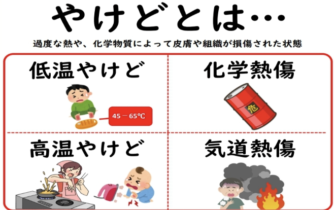 やけどとは？